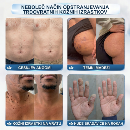 Uradna trgovina|💎𝐇𝐈𝐒𝐊𝐈𝐍®7 dnevni odstranjevalec kožnih izrastkov in madežev(𝐫𝐨𝐥𝐥-𝐨𝐧 𝐚𝐩𝐥𝐢𝐤𝐚𝐭𝐨𝐫: 𝐛𝐫𝐞𝐳 𝐛𝐨𝐥𝐞č𝐢𝐧 𝐢𝐧 𝐛𝐫𝐚𝐳𝐠𝐨𝐭𝐢𝐧)🌳