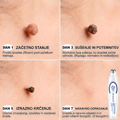 Uradna trgovina|💎𝐇𝐈𝐒𝐊𝐈𝐍®7 dnevni odstranjevalec kožnih izrastkov in madežev(𝐫𝐨𝐥𝐥-𝐨𝐧 𝐚𝐩𝐥𝐢𝐤𝐚𝐭𝐨𝐫: 𝐛𝐫𝐞𝐳 𝐛𝐨𝐥𝐞č𝐢𝐧 𝐢𝐧 𝐛𝐫𝐚𝐳𝐠𝐨𝐭𝐢𝐧)🌳